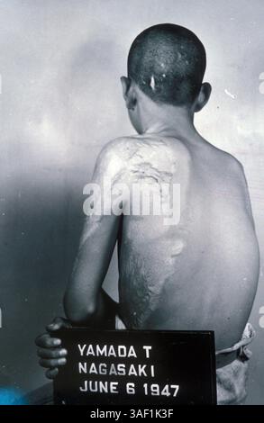 05 lug 2005; Nagasaki, Giappone; foto file, data sconosciuta. La schiena di una donna vittima di avvelenamento da radiazioni a causa dell'attentato di Nagasaki. Credito obbligatorio: Foto di ZUMA Archive/ZUMA Press. (©) Copyright 2005 di ZUMA Archive Foto Stock