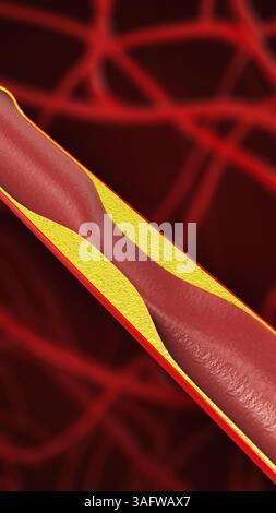 Arteria dei vasi sanguigni bloccata con colesterolo Foto Stock