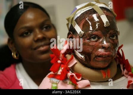 29 maggio 2008 - Cincinnati, Ohio, Stati Uniti - DAVANA PRESSLEY, 25 anni, e MAKEILA PRESSLEY, 9 anni, Makeila indosserà una maschera di plastica per un anno e mezzo per prevenire il disagio. Ha subito 14 interventi chirurgici di trapianto di pelle da quando è stata ricoverata negli ospedali Shriners per bambini a Cincinnati nel mese di febbraio. Makeila Pressley, 9 anni, è sopravvissuta a un incendio a Clearwater a febbraio ed è in cura presso gli ospedali Shriners per bambini a Cincinnati. NELLA FOTO: 28 aprile 2008 (immagine di credito: St Petersburg Times/ZUMAPRESS.com) Foto Stock