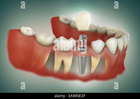 L'illustrazione in 3D di un impianto dentale a dente singolo mostra separatamente ogni componente della procedura (impianto, abutment e corona). Foto Stock