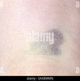 Primo piano livido viola sulla pelle. Livido causato dall'impatto. Lividi ed ematoma sul corpo umano Foto Stock