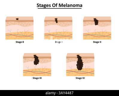 Fasi dell'illustrazione vettoriale del melanoma Illustrazione Vettoriale