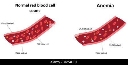 Illustrazione dell'anemia e del normale vettore della conta eritrocitaria Illustrazione Vettoriale