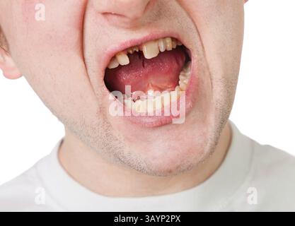 Giovane uomo faccia con dente rotto, primo piano isolato su bianco Foto Stock