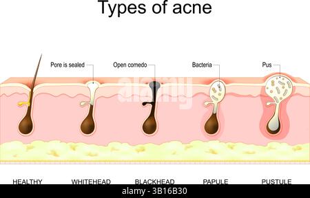 Tipi di brufoli dell'acne. Pelle sana, teste bianche e nere, papule e pustole. Illustrazione vettoriale. Poster medico. Diagramma schematico Illustrazione Vettoriale