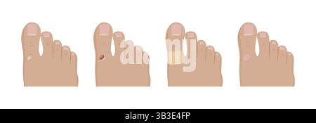 Illustrando quattro fasi di una vescica di attrito che si sviluppa su un dito del piede, passando da una pelle sana a una ferita aperta, seguita da guarigione con un adesivo Illustrazione Vettoriale