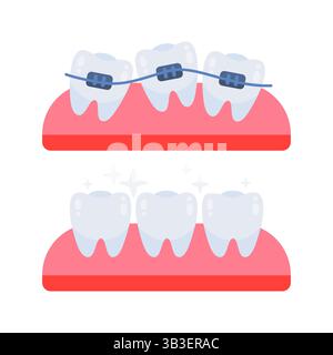 Raddrizzamento dei denti con rinforzi che mostrano le fasi prima e dopo Illustrazione Vettoriale
