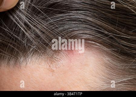 Primo piano del carcinoma basocellulare sul cuoio capelluto, evidenziando il cancro della pelle e l'esame dermatologico Foto Stock