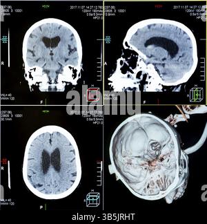 Risonanza magnetica (RM): Scansioni TC della testa umana su un monitor di un computer a ultrasuoni Foto Stock