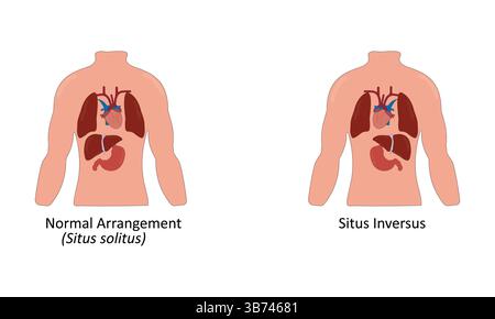 Illustrazione del vettore situs inversus Illustrazione Vettoriale