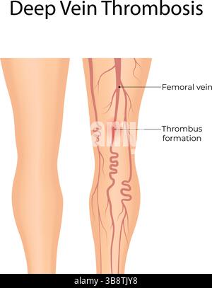 Trombosi venosa profonda comprensione dei coaguli di sangue nelle vene illustrazione vettoriale Illustrazione Vettoriale