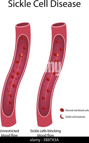 Illustrazione del vettore di flusso sanguigno: Anemia a cellule falciformi normale vs anemia a cellule falciformi Illustrazione Vettoriale