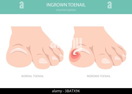 L'unghia incarnita, o onicocriptosi, è una condizione delle unghie che causa dolore, arrossamento e gonfiore man mano che l'unghia cresce nella pelle. Infografica medica. VEC Illustrazione Vettoriale