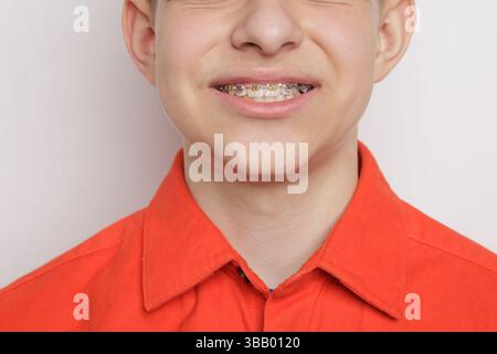 Adolescente sorridente con le armature dentali colorate, primo piano dell'allineamento dei denti e progressi nel trattamento ortodontico. Foto Stock