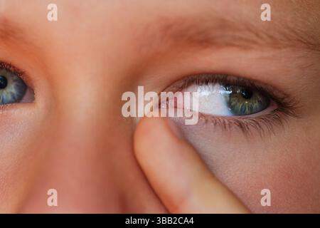 Ragazzo allergico che gratta gli occhi da vicino Foto Stock