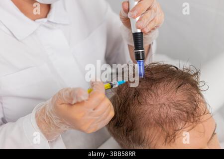 Alopecia. Perdita di capelli uomo migliorare il trattamento di crescita rigenerazione dermapen microneedling vitamine esosomi iniezioni di siringhe di plasma. Cosmetologo tricologo medico procedura testa mesoterapia frazionaria Foto Stock