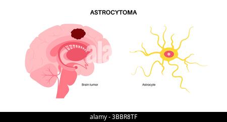 Illustrazione di un astrocitoma. Si tratta di un tipo di tumore cerebrale che ha origine da astrociti, cellule gliali a forma di stella che supportano le cellule nervose nel cervello e nel midollo spinale. Foto Stock