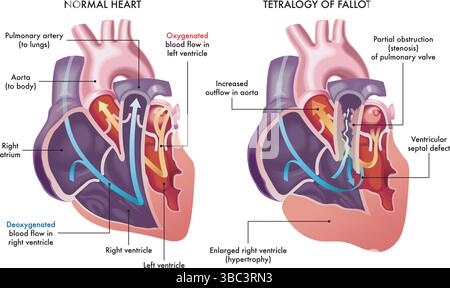 Illustrazione che mostra un cuore normale e uno con sintomi di Tetralogia di Fallot, una malattia cardiovascolare, con annotazioni. Illustrazione Vettoriale