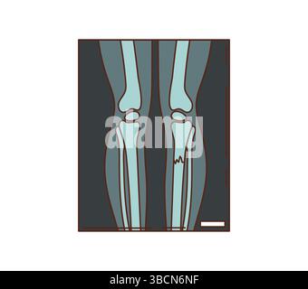 Scansione a raggi x Cartoon Groovy che mostra le ossa delle gambe umane, con una frattura visibile su un lato. medicina e corpo umano icona vettore medico rappresenta radiologia, salute delle ossa, diagnosi di lesioni e assistenza sanitaria Illustrazione Vettoriale