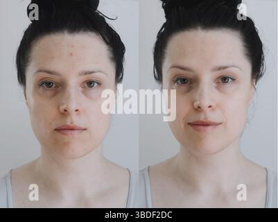 Faccia femminile confronto a lungo termine prima e dopo le procedure cosmetiche Foto Stock
