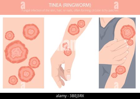 Tinea. Tigna. Malattie della pelle. Progettazione infografica medica. Illustrazione vettoriale Illustrazione Vettoriale