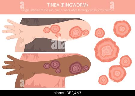 Tinea. Tigna. Malattie della pelle. Progettazione infografica medica. Illustrazione vettoriale Illustrazione Vettoriale