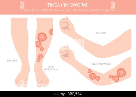 Tinea. Tigna. Malattie della pelle. Progettazione infografica medica. Illustrazione vettoriale Illustrazione Vettoriale