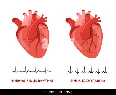 Malattie cardiache. Ritmo sinusale normale e tachicardia sinusale. Controllo medico. Illustrazione vettoriale in stile cartone animato piatto Illustrazione Vettoriale