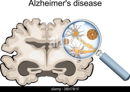 Morbo di Alzheimer. Neurodegenerazione. Sezione trasversale del cervello di Alzheimer, con atrofia della corteccia cerebrale, ventricoli ingrossati e ippocampo. Un Illustrazione Vettoriale