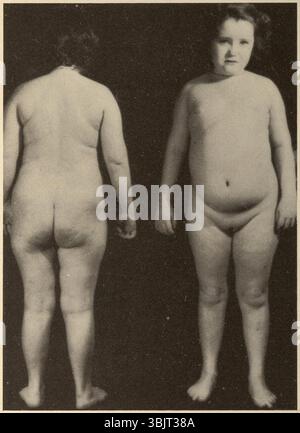 Sindrome di Laurence-Moon-Biedl 4. Foto Stock