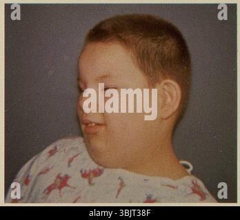 Sindrome di Laurence-Moon-Biedl 2. Foto Stock