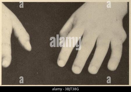 Sindrome di Laurence-Moon-Biedl 5. Foto Stock