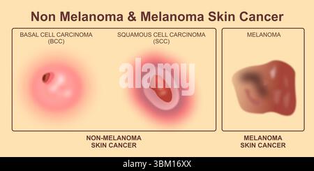 Cancro cutaneo non melanoma e melanoma Foto Stock