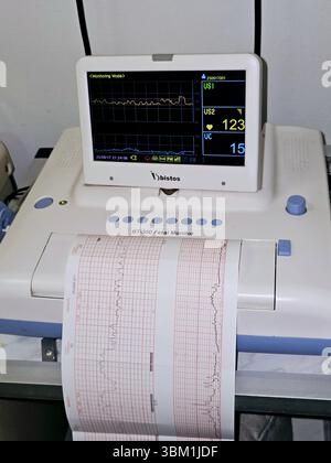 Cairo, Egitto, 17 giugno 2025: Dispositivo di cardiotocografia posizionato sull'addome della madre che registra la frequenza cardiaca fetale ottenuta tramite trasduttore a ultrasuoni, CTG Foto Stock