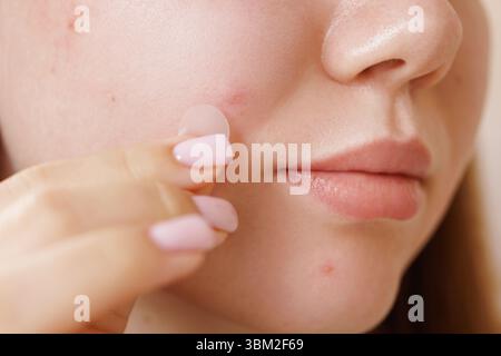 Primo piano di una giovane donna che applica un cerotto rotondo di acne idrocolloide su difetti per la cura della pelle e del brufolo Foto Stock