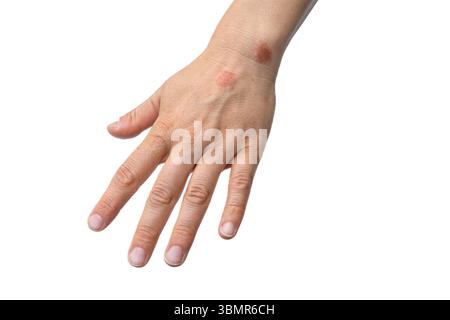 Eczema colpito mano umana isolato su sfondo bianco, Un caso di dermatite caratterizzato da prurito, arrossamento e un'eruzione cutanea Foto Stock
