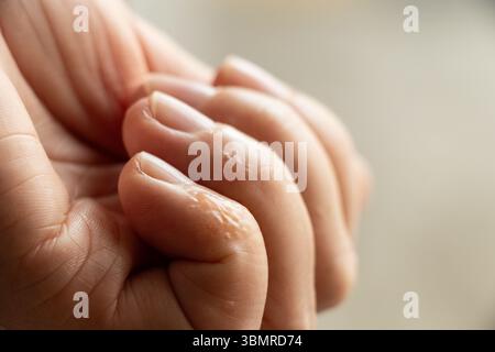 Primo piano del dito con eruzione cutanea e irritazione cutanea dovuta all'allergia alla mano della ragazza Foto Stock