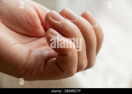 Primo piano del dito con eruzione cutanea e irritazione cutanea dovuta all'allergia alla mano della ragazza Foto Stock