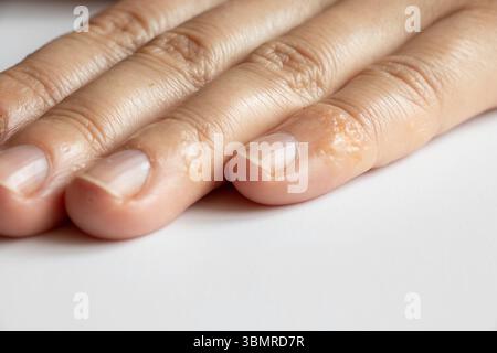 Primo piano del dito con eruzione cutanea e irritazione cutanea dovuta all'allergia alla mano della ragazza Foto Stock