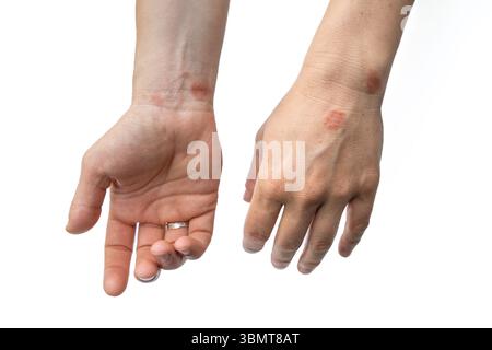 Un caso medico di dermatite caratterizzata da prurito, rossore e un rash, entrambe le mani colpite da eczema isolato su bianco Foto Stock