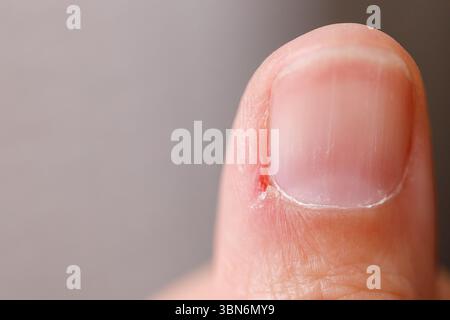 Inconveniente infiammato su Finger Macro Close-up Foto Stock