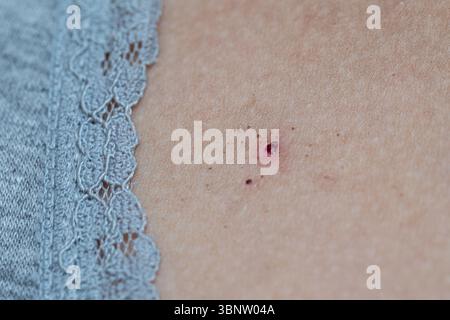 Primo piano di eruzione cutanea dolorosa con vesciche che causano prurito e sensazione di bruciore Foto Stock