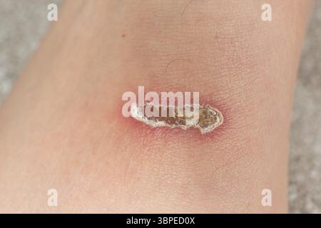 Abrasioni sulla sommità dei piedi dopo il nuoto con le pinne. Foto Stock