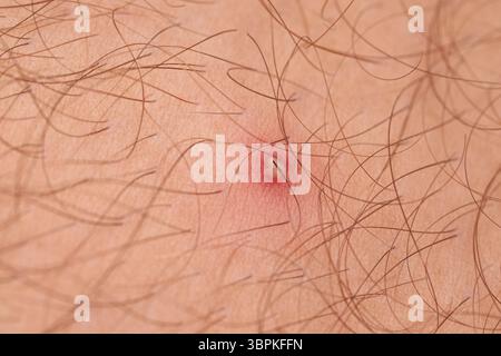 Peli incarniti con brufolo sulla pelle umana primo piano. Dermatologia, igiene e cura della pelle. Foto Stock