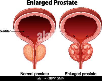 Illustrazione vettoriale che mostra le differenze anatomiche tra la prostata normale e quella ingrandita. Etichettatura chiara e vista in sezione trasversale dettagliata Illustrazione Vettoriale