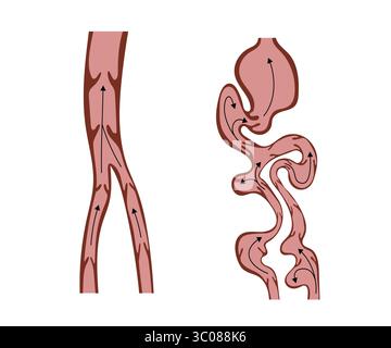 Illustrazione medica che confronta il flusso sanguigno sano nelle vene normali con il flusso sanguigno interrotto nelle vene varicose, evidenziando l'importanza di vascolare Illustrazione Vettoriale