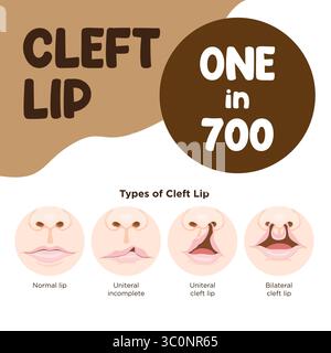Nel diagramma dei neonati si osservano le condizioni normali e unilaterali del labbro e del palato della spaccatura e le condizioni del labbro e del palato della spaccatura bilaterale. illustrazione vettoriale schematica disegnata a mano Illustrazione Vettoriale
