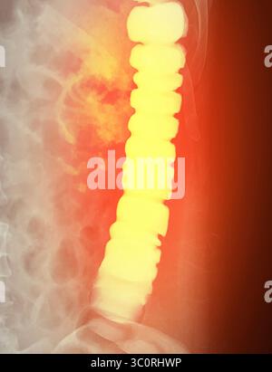 Immagine diagnostica dell'enema del bario che mostra la presenza di diverticolosi nel colon trasversale e ascendente, dimostrando la tipica f diverticolare Foto Stock