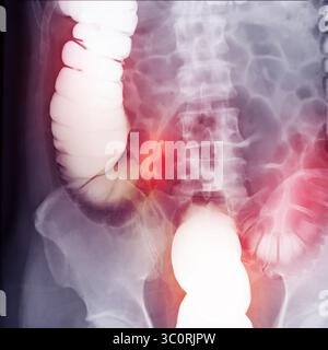 Immagine diagnostica dell'enema del bario che mostra la presenza di diverticolosi nel colon trasversale e ascendente, dimostrando la tipica f diverticolare Foto Stock
