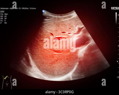 Ecografia normale della parte superiore dell'addome, che mostra organi sani senza anomalie. Immagini chiare del fegato, del pancreas e dello strutturatore circostante Foto Stock